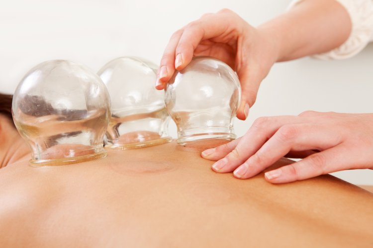 A deep insight about Cupping A deep insight about Cupping